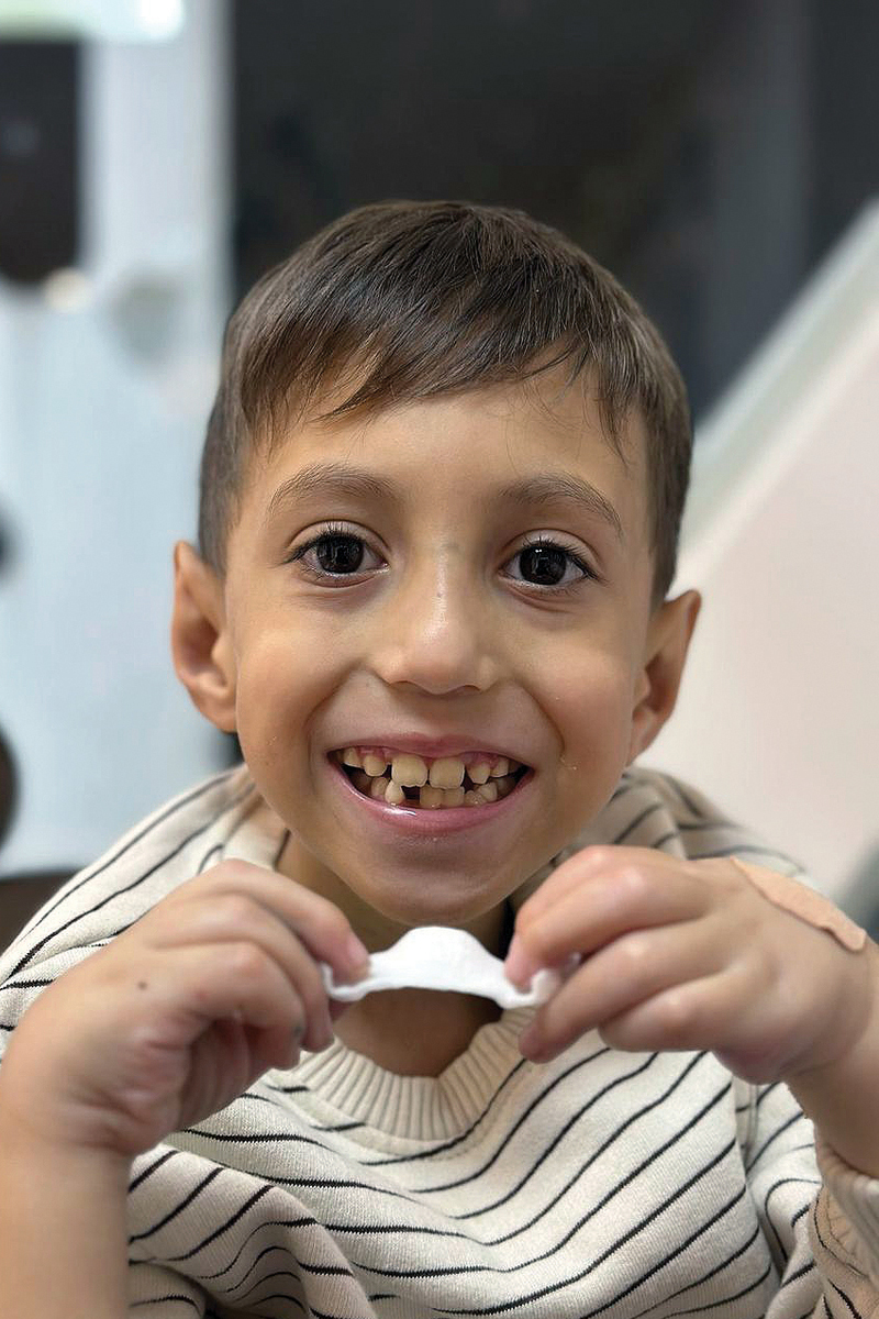 Benício Venâncio Brasil iniciou o tratamento com o IPP (Invisalign Palatal Expander) e está adorando a praticidade e os resultados do aparelho.