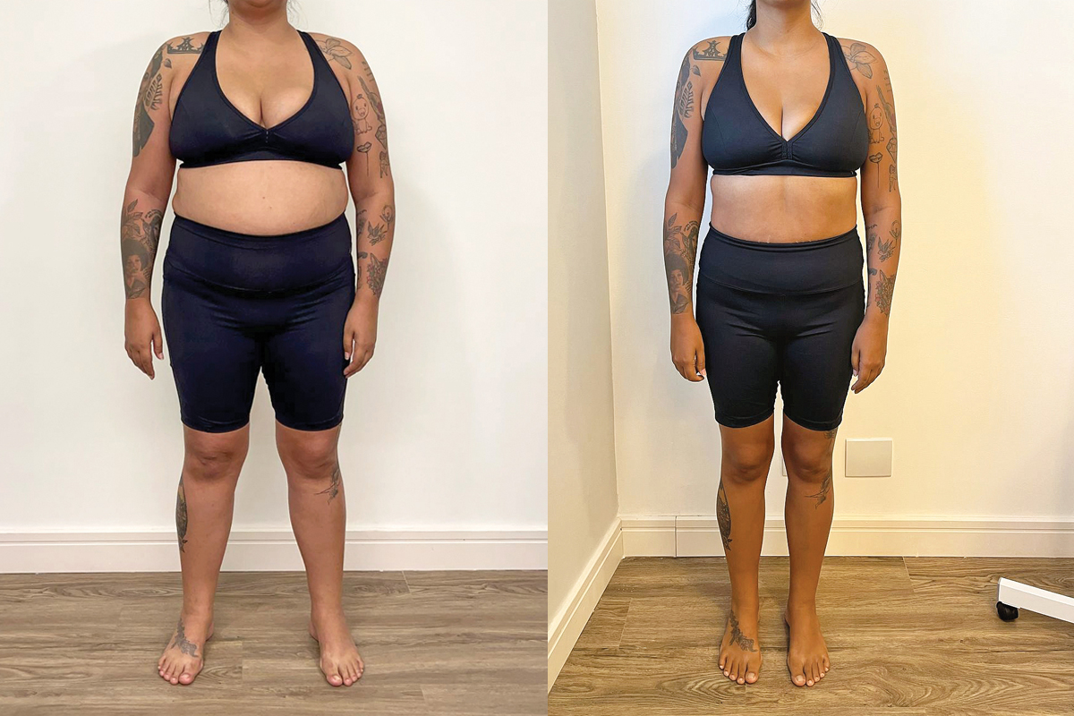 Raquel iniciou o Programa de Saúde e Bem-Estar com o Dr. Igor Alves dia 30/09/2024. Nas primeiras 11 semanas, já havia eliminado 20kg de gordura e sua insulina já tinha normalizado. Nessas fotos, a diferença é de 30kg perdidos de maneira leve e consistente.